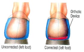 orthotic-correction
